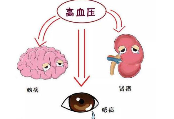 高血壓有哪幾種類型？高血壓要做些什么檢查項目？