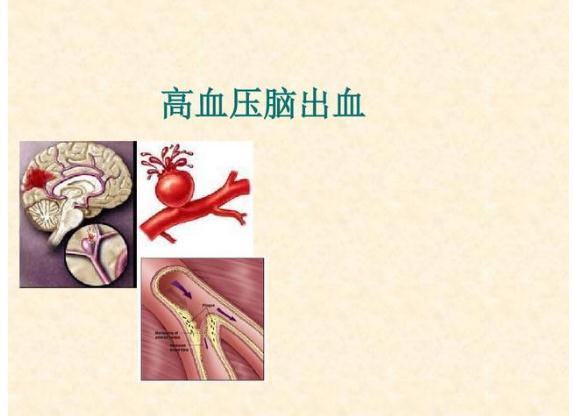 高血壓為什么會(huì)引起腦出血？高血脂會(huì)引起高血壓嗎？