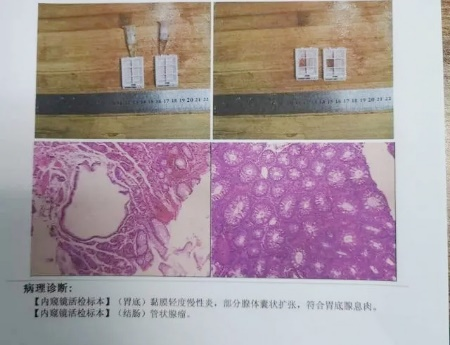 廣州東大肛腸醫(yī)院好不好34歲女士腸息肉切除后3年不查，拖出腸癌