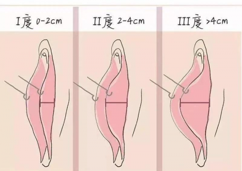 陰唇肥大又看不見，手術還有必要做嗎？在昆明這里告訴你!