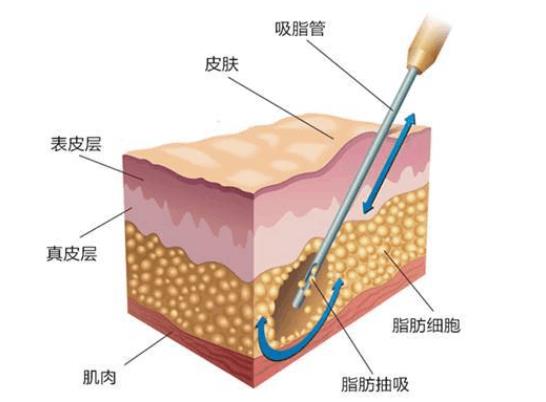 吸脂肪對(duì)身體有害嗎 吸脂肪手術(shù)需要多少錢