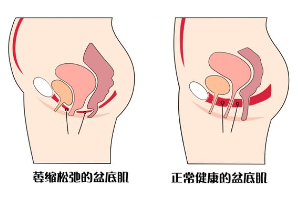 盆底肌受損影響生育嗎 盆底肌受損嚴重還能恢復(fù)嗎