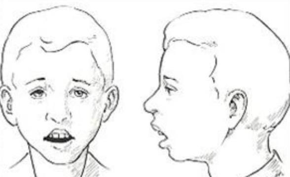 腺樣體面容如何矯正 飲食藥物手術(shù)調(diào)理改善