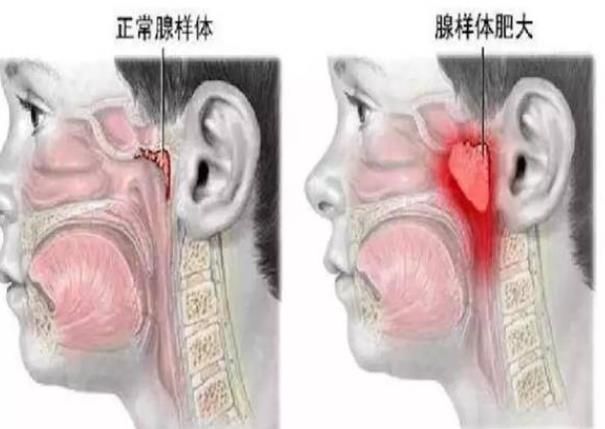 腺樣體肥大一定要做手術嗎 看臨床表現(xiàn)及藥物治療反應