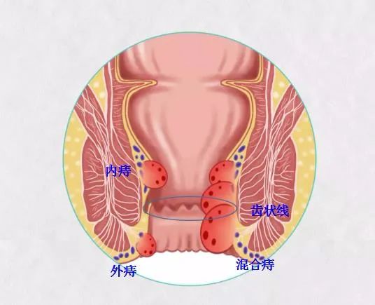 痔瘡之痛何以解，揚州妙手肛腸醫(yī)院為痔瘡病友解決“難言之苦”