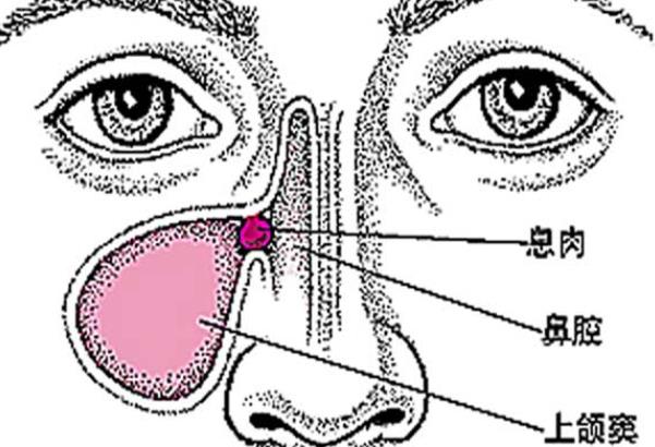 引起鼻息肉的原因有哪些 慢性感染感冒鼻塞飲食個人衛(wèi)生等