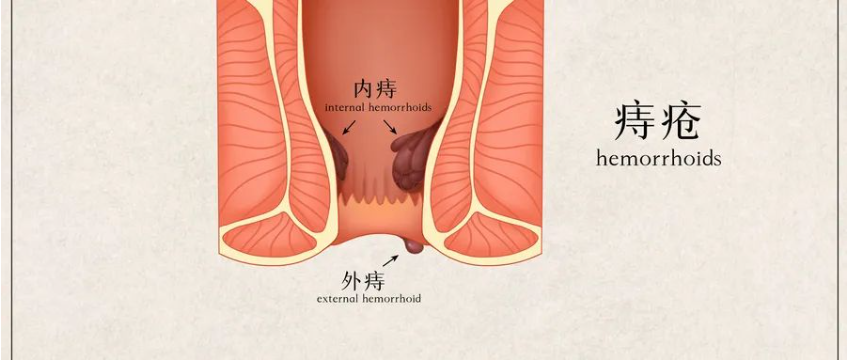 【北京豐益肛腸醫(yī)院】導(dǎo)致炎性外痔的主要原因有哪些？