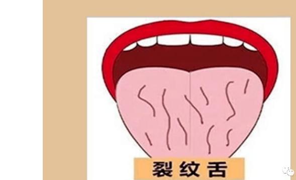 舌頭有裂紋是怎么回事？舌頭有裂紋要治療嗎？