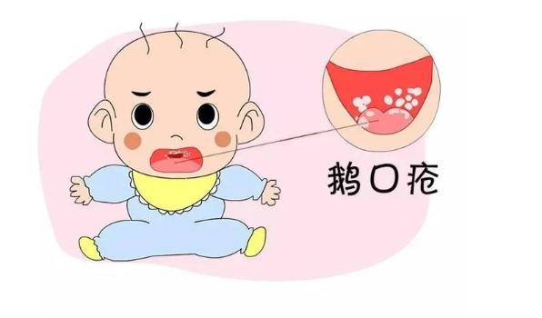 鵝口瘡是怎么引起的？寶寶得鵝口瘡怎么護(hù)理？