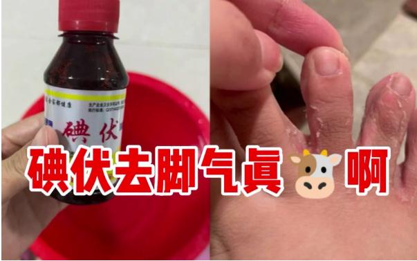 碘伏能治療腳氣嗎？腳氣是缺乏維生素嗎？