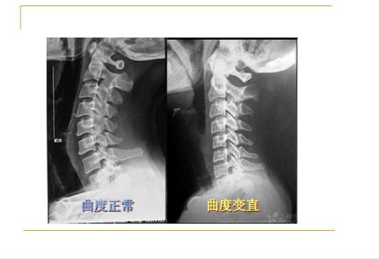 頸椎病能引起后背疼嗎？頸椎病的鑒別診斷有哪些？