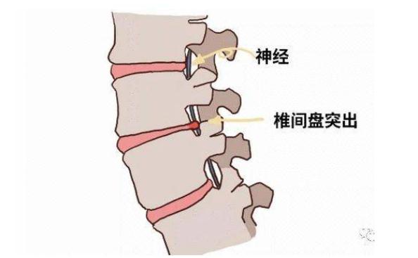 腰間盤(pán)突出吃什么藥？腰間盤(pán)突出能治愈嗎？