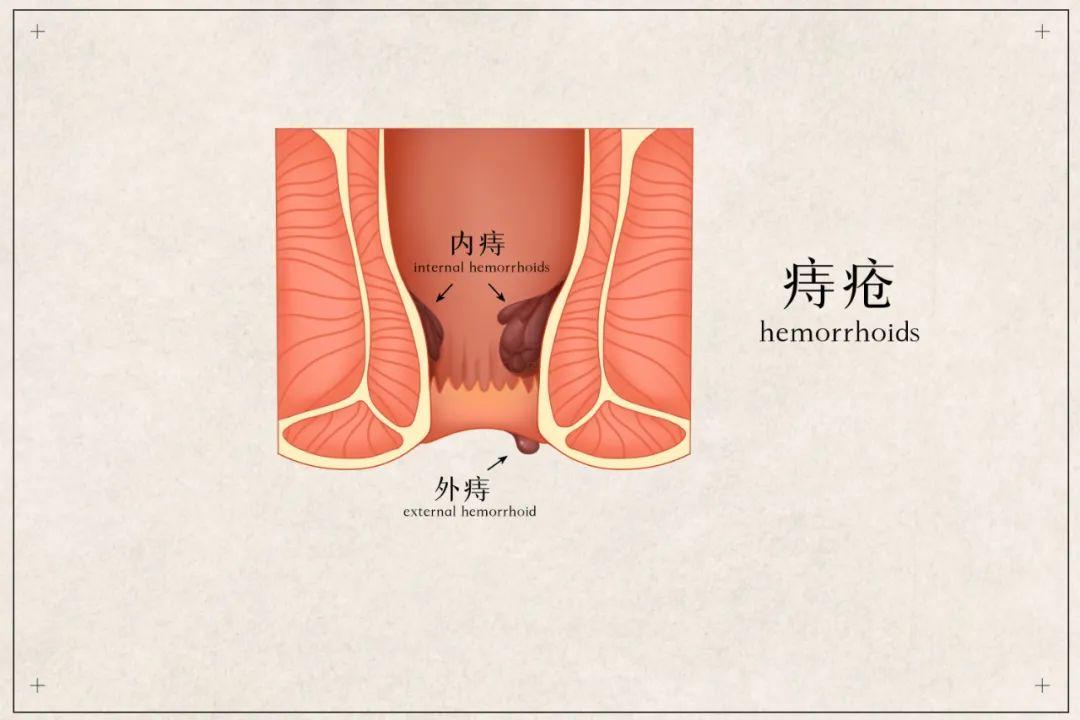 包頭東大肛腸?？漆t(yī)院詳解痔瘡與肛裂如何區(qū)分