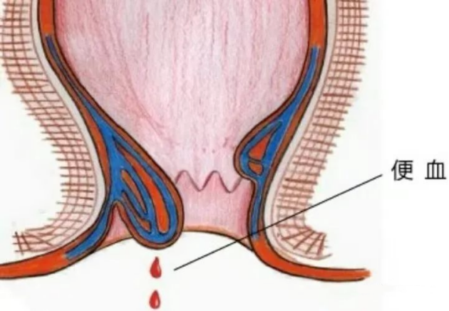 保定東大肛腸醫(yī)院丨肛腸疾病不都是痔瘡的“鍋”，這些疾病都不能忽視！