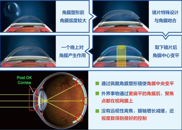 合肥愛爾眼科：角膜塑形鏡只要戴上就行？你想簡單了！