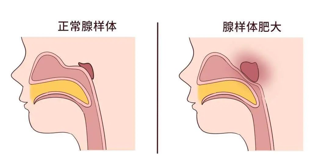 為什么現(xiàn)在患腺樣體肥大的孩子越來越多？聽聽成都民生耳鼻喉醫(yī)院怎么說