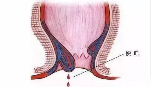 保定東大肛腸醫(yī)院丨肛腸疾病千萬別硬抗，這六種癥狀一定要去醫(yī)院！