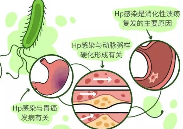 幽門螺桿菌會傳染給小孩嗎 幽門螺桿菌如何傳染給小孩