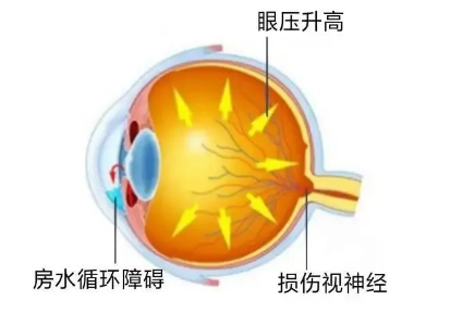 合肥愛(ài)爾眼科：青光眼嚴(yán)重嗎？它可能會(huì)致盲！