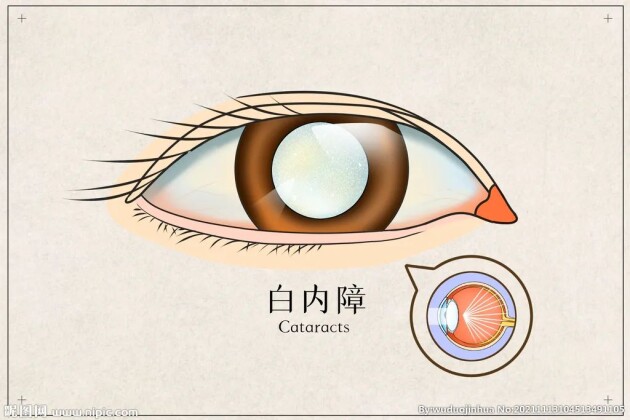 眼前好像蒙了一層霧，是白內(nèi)障嗎？這5大癥狀，轉(zhuǎn)發(fā)給父母自查——福州愛爾