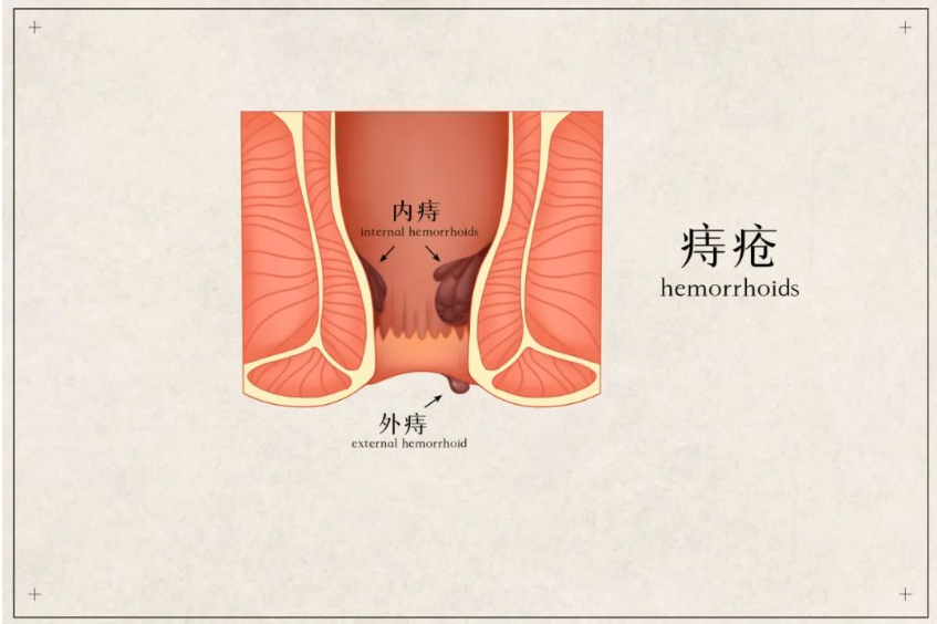 【北京豐益肛腸醫(yī)院】痔瘡