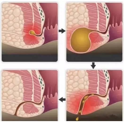 保定東大肛腸醫(yī)院看肛腸疾病怎么樣？這種高發(fā)的肛門(mén)疾病發(fā)病率僅次于痔瘡，卻幾乎無(wú)法自愈！!!!!!