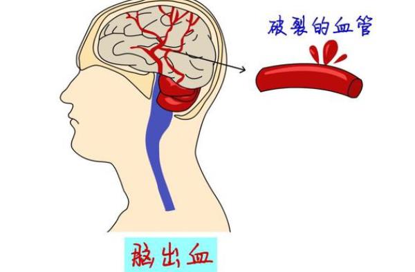 哪些人腦溢血概率高 為什么三高人群容易腦溢血