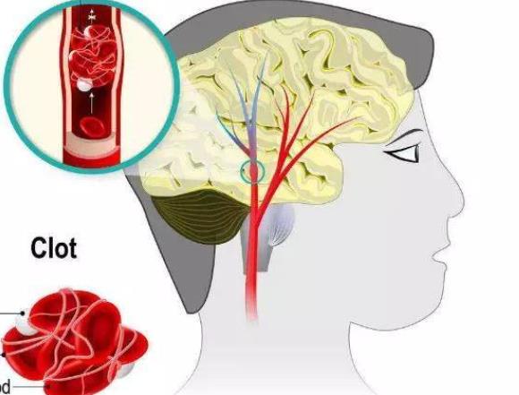 腦梗塞能治好嗎 年輕人如何預(yù)防腦梗塞