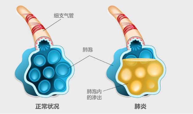 流感疫苗可以預防肺炎嗎 ？支原體肺炎更易侵襲小學生嗎？