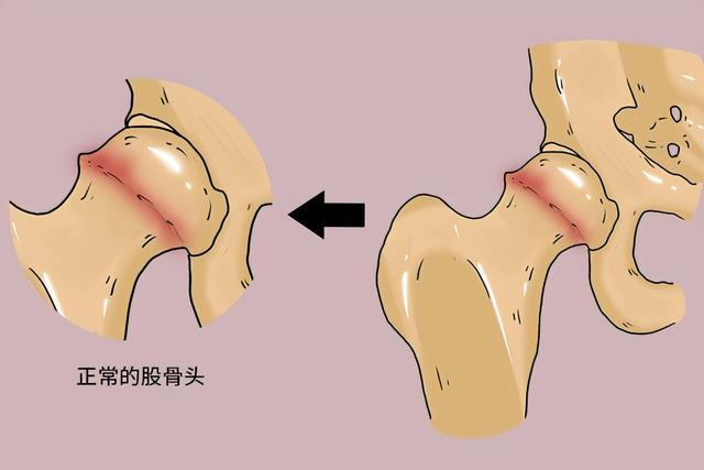 股骨頭壞死平常怎么養(yǎng)？專家推薦天然中成藥