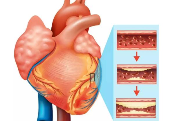 冠心病是心臟病嗎？冠心病是傳染病嗎？