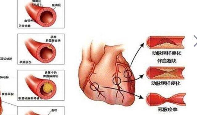 冠心病吃什么好？治療冠心病要多少錢？