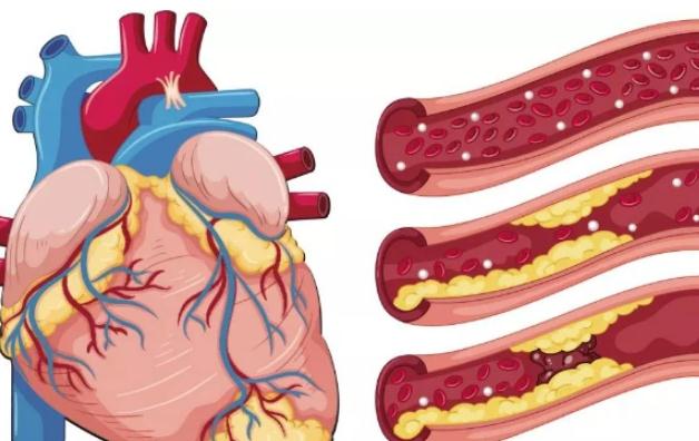 冠心病預(yù)防與保健 ？冠心病的分類？