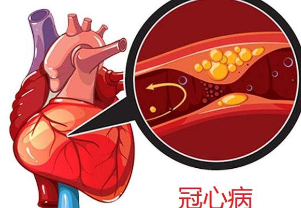 冠心病會引起頭暈嗎？冠心病會引起腳腫嗎？