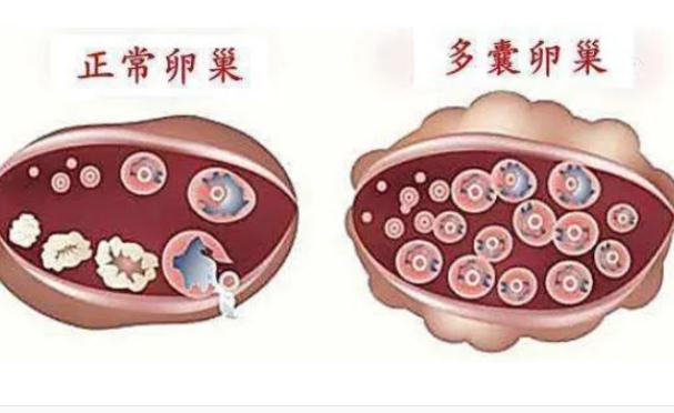 樣預(yù)防多囊卵巢？多囊為什么肚子大？