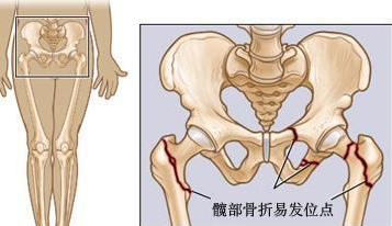 這些股骨頭壞死信號不容忽視，早期股骨頭壞死的保守治療