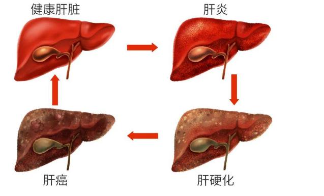 丁型肝炎有什么危害呢？丁型肝炎的癥狀有什么呢？