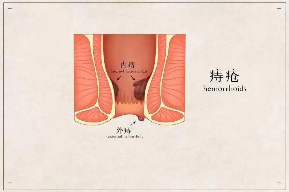 包頭東大肛腸專科醫(yī)院詳解痔瘡不痛不癢不用管?這5種痔瘡真的留不得!