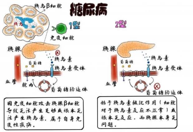 高血糖有哪些并發(fā)癥 愛吃辣的人會(huì)得糖尿病嗎