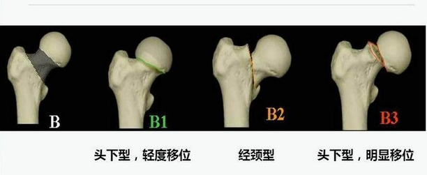 股骨頭壞死早期有效治愈方法迎來全新進(jìn)展，中成藥將是關(guān)鍵