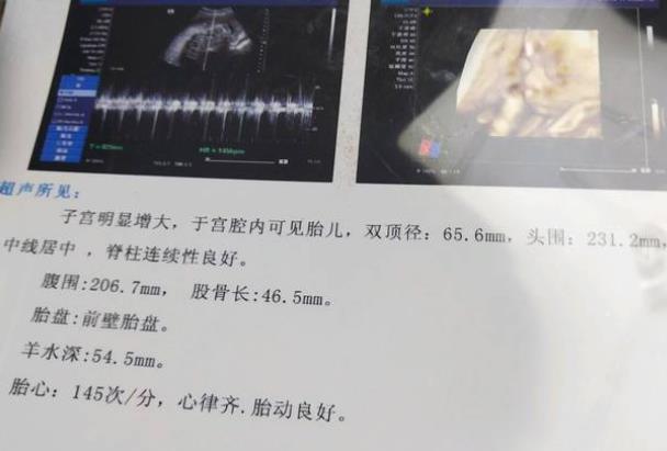 四維彩超要做幾次 四維能做兩次嗎