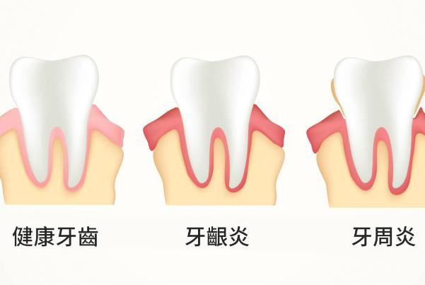 牙周炎能吃海鮮嗎？牙周炎如何自我判斷？