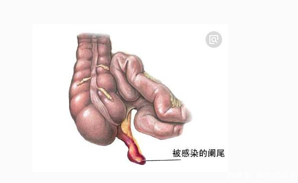 急性闌尾炎保守治療需要幾天 急性闌尾炎保守治療會復發(fā)嗎