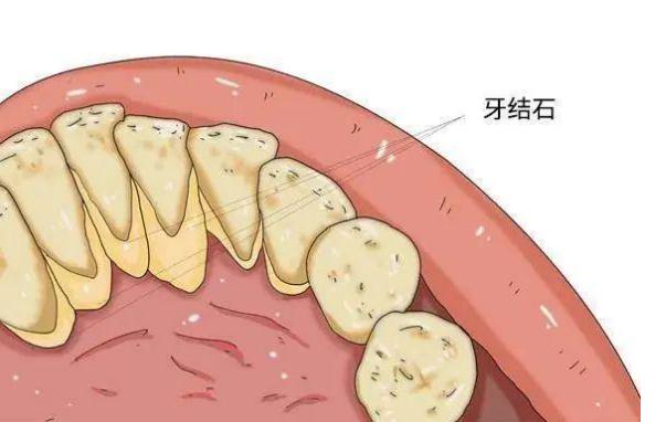 牙周炎可以用沖牙器嗎 ？牙周炎吃什么好？