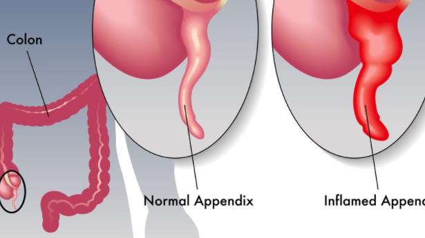 闌尾炎會(huì)遺傳嗎 闌尾炎的病因是什么