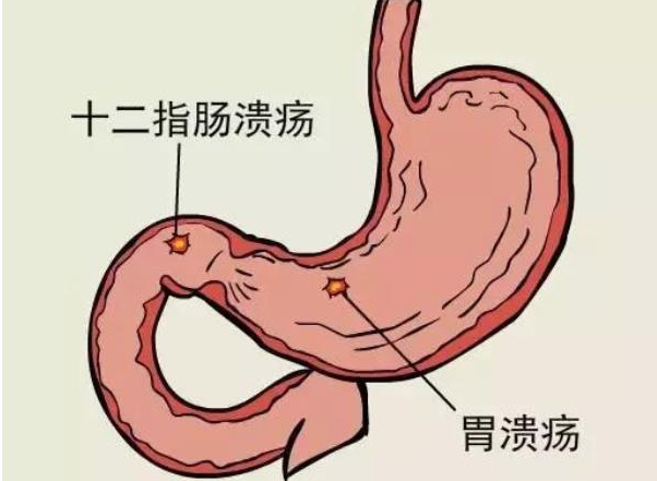 胃潰瘍會(huì)造成幽門梗阻嗎 胃潰瘍嚴(yán)重了會(huì)怎樣