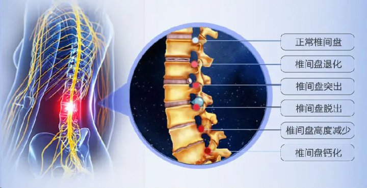 腰椎間盤突出久治不愈，快來試試仙濟(jì)玉靈貼！