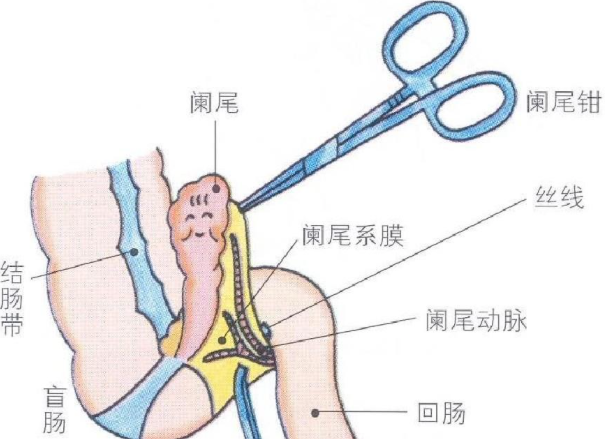 闌尾炎會死亡嗎 闌尾炎怎么辦