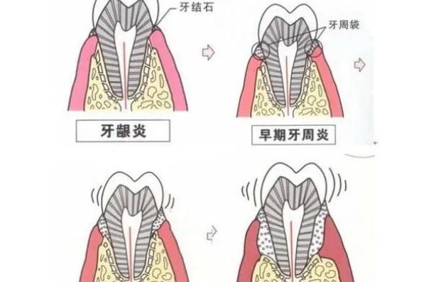 牙周炎會(huì)癌變嗎？牙周炎會(huì)病變嗎？