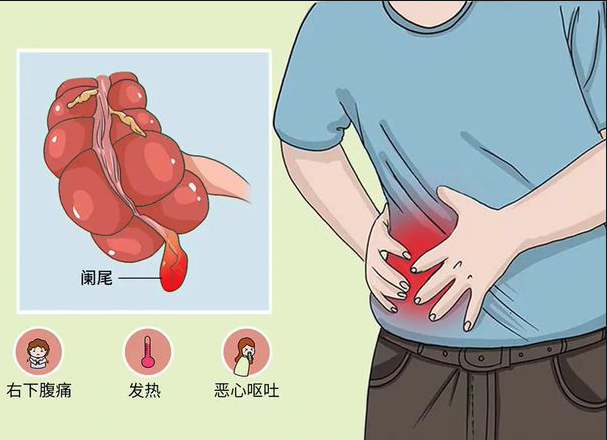 慢性闌尾炎懷孕有影響嗎 慢性闌尾炎會(huì)不會(huì)穿孔